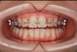 splintset.JPG (4964 �o�C�g)